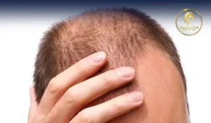 FUE Hair Transplant Cost In Dubai